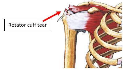 Rotator Cuff Tear Repair 